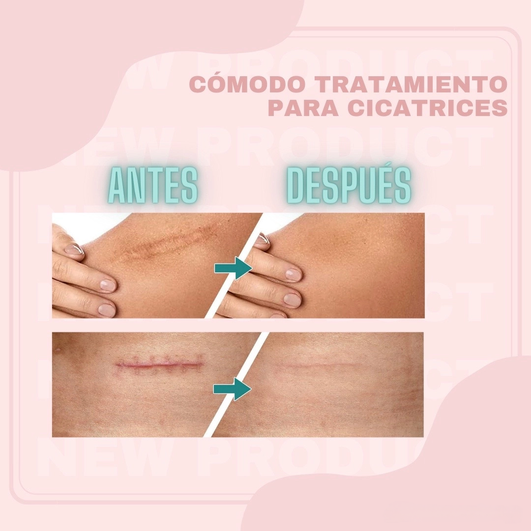 Cinta De Silicona Para Cicatriz