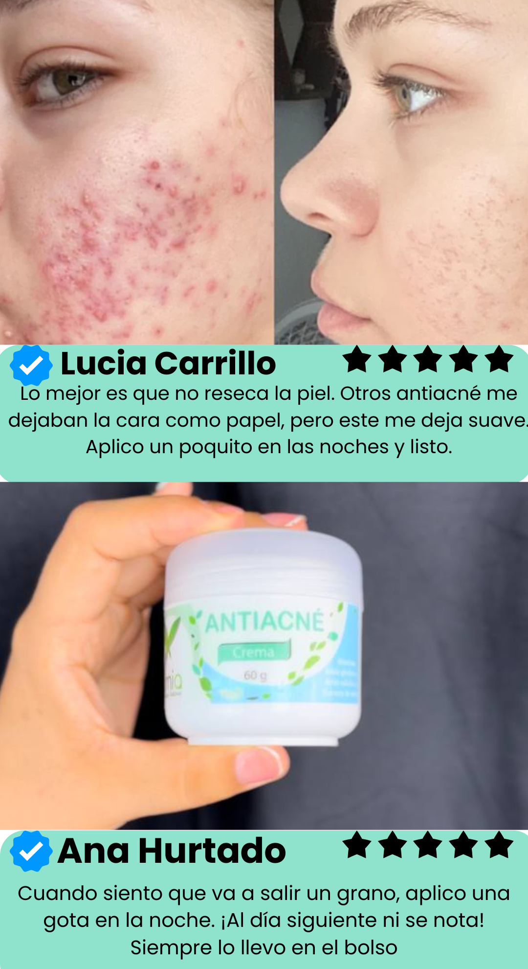 Crema Zamia Anti Acné 2x1